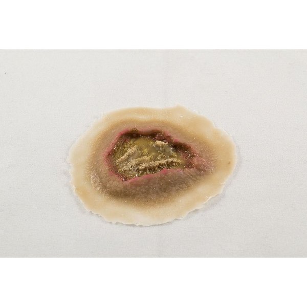 Moulage Science & Training Small Ulcer, Medium, PK 6 MST-46-03-06
